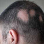calvicie-alopecia