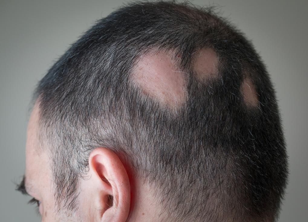 ¿Cuáles son los diferentes tipos de alopecia areata?