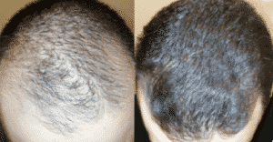 ¿Es la densidad más importante que el grosor del cabello para los trasplantes de cabello?