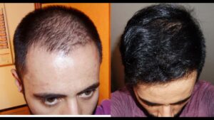 Fotos de antes y después de dutasterida y minoxidil