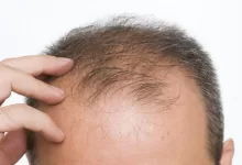 ¿La caída del cabello es un síntoma de COVID-19?