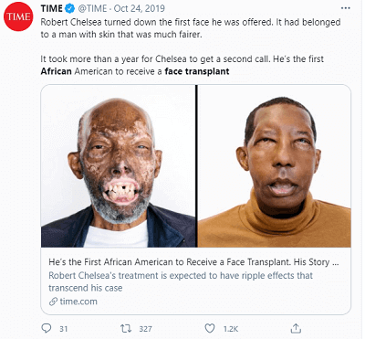 African Face Transplant