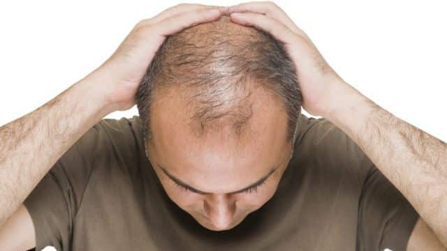 Cómo controlar la caída genética del cabello