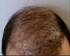 Desastre absoluto – Trasplante de cabello FUE en Turquía – Últimas noticias / actualizaciones sobre trasplante de cabello