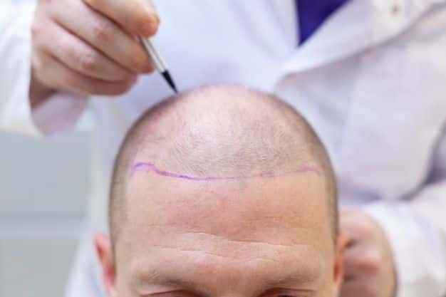 Líneas capilares para trasplante de cabello