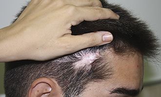 ¿Miedo a las cicatrices?  – Últimas noticias / actualizaciones sobre trasplantes de cabello