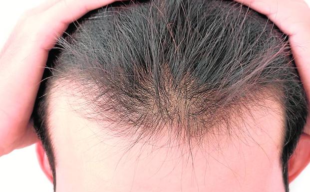 El mejor resultado de trasplante de cabello en Indore (4 meses 11 días)