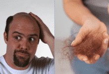 Medicamentos que pueden causar pérdida de cabello
