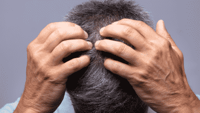 ¿La caspa provoca la caída del cabello?  – cabello a base de hierbas