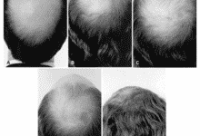 Tratamiento con estrógenos y crecimiento del cabello.