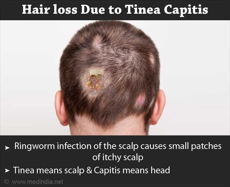 Pérdida de cabello causada por tiña capitis