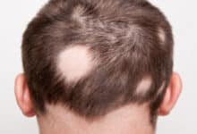 ¿Qué es la alopecia areata?  Síntomas, causas, diagnóstico y tratamiento