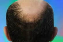 Los mejores consejos para prevenir la caída del cabello / Cómo detener la caída del cabello