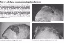 Hirsutismo parcial adquirido | Tratamiento anticaída del cabello 2020