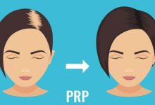 ¿Qué es la terapia de plasma rico en plaquetas (PRP) para la caída del cabello?