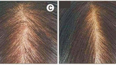 El láser fraccionado estimula el crecimiento del cabello