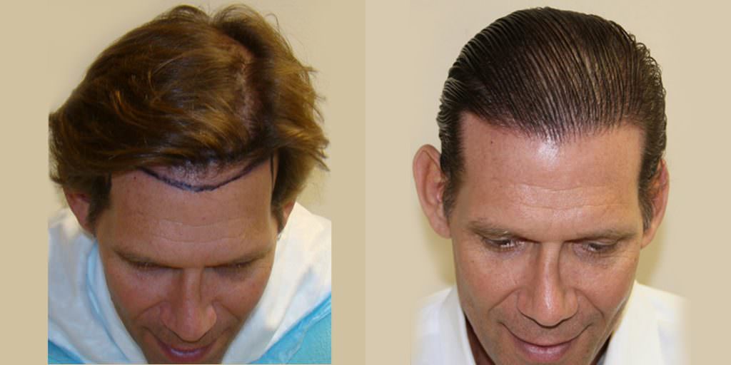 Los propios asesores de pacientes del Dr. Bolton realizan trasplantes de cabello MaxHarvest™ antes y después del proceso de curación/crecimiento de la línea del cabello.