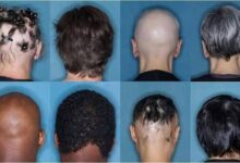 Baricitinib (Olumiant) recibe la aprobación de la FDA para la alopecia areata