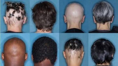 Baricitinib (Olumiant) recibe la aprobación de la FDA para la alopecia areata
