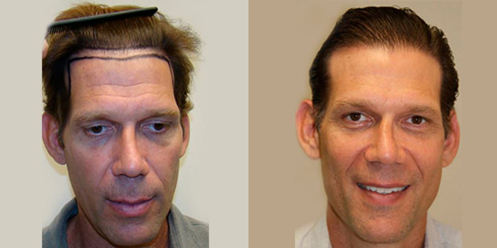 Los propios asesores de pacientes del Dr. Bolton realizan trasplantes de cabello MaxHarvest™ antes y después del proceso de curación/crecimiento de la línea del cabello.