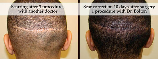 ¿Miedo a las cicatrices?Exponer suturas/cicatrices antes y después de la industria del trasplante capilar